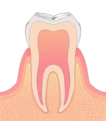 C0: エナメル質が溶けはじめ、白く濁っている