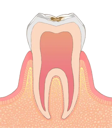 C1: エナメル質がさらに溶け、黒ずみはじめる