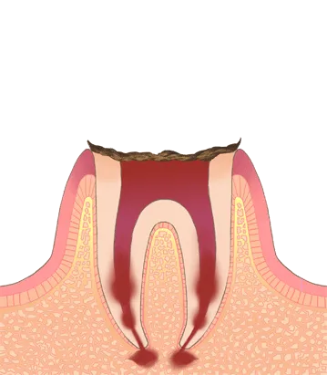 C4: 歯の大部分が溶けてなくなり、歯根まで虫歯菌に侵食される