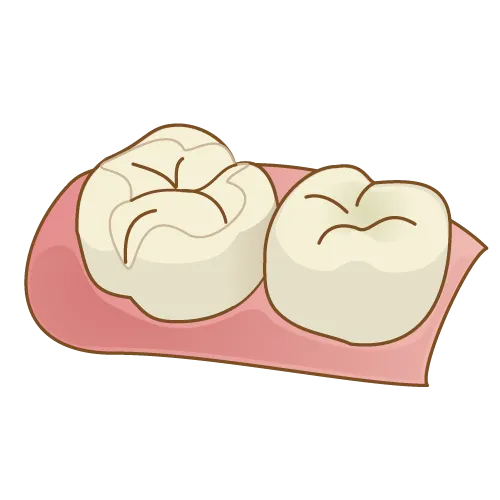 セラミックインレー