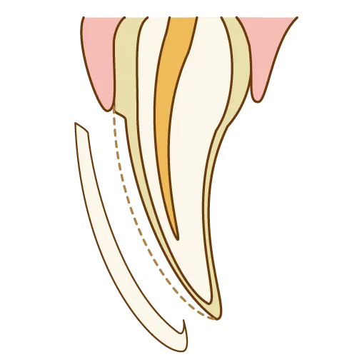 ラミネートベニア